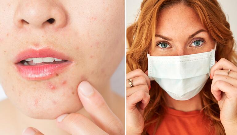 6 tips para combatir el acné provocado por el uso de la mascarilla