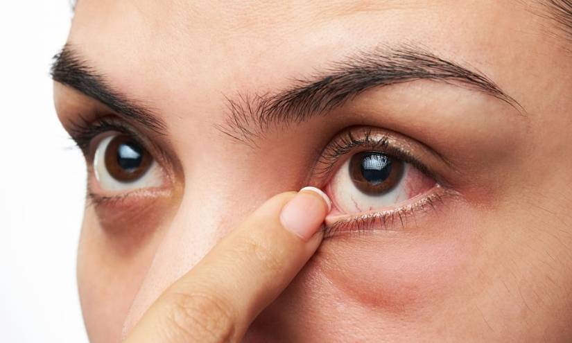 Conjuntivitis puede ser único síntoma de COVID-19